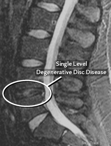 Degenerative Disc Disease (DDD)